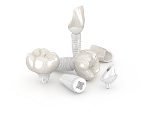 ceramic dental implants